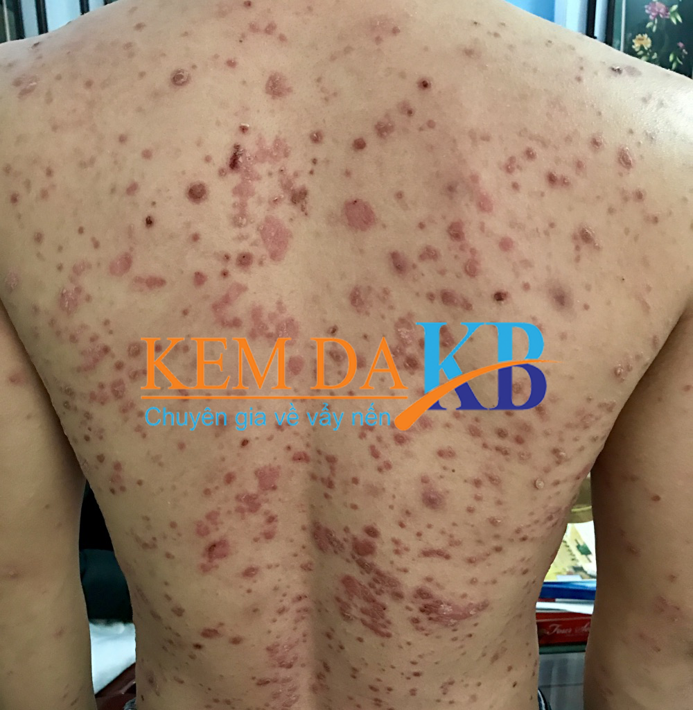vẩy nến thể giọt